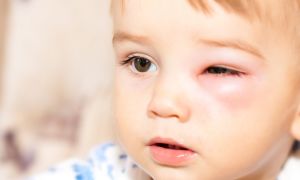 Причины и лечение отечности глаз у ребенка