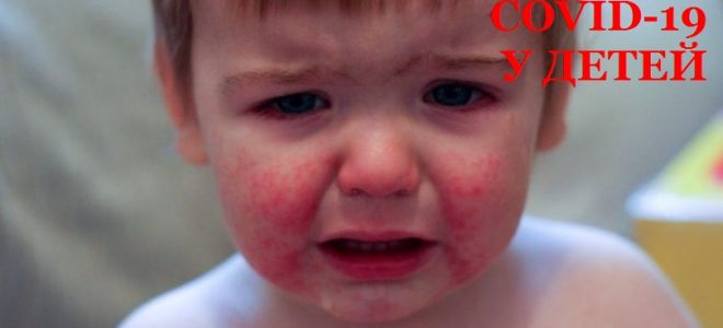 Осложнения у детей после Коронавируса (и синдром Кавасаки)