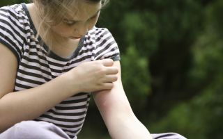 Аллергия на укусы комаров и прочих насекомых у детей