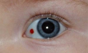 Лопнул сосуд в глазу у ребенка — причины и профилактика состояния