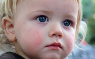Диатез у детей: синдром красных щечек