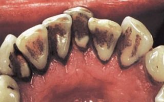 Выяснение причин и избавление ребенка от черного налета на зубах