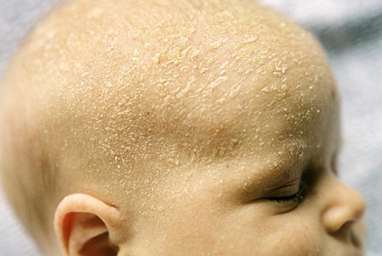 саборейный дерматит на голове у малыша