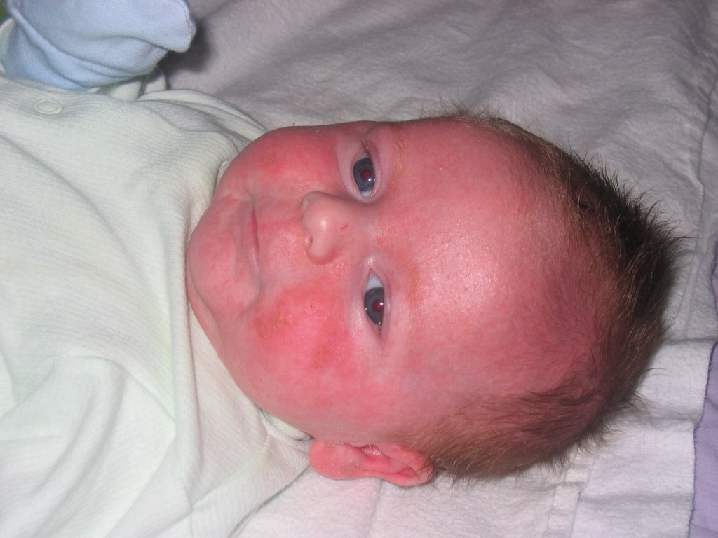 Почему у новорожденного может быть. Золотуха, золотистый стафилококк. Токсическая эритема новорожденных.