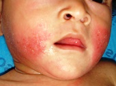 Атопический дерматит на лице у ребенка