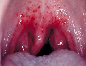 Так выглядит герпетическая ангина во рту