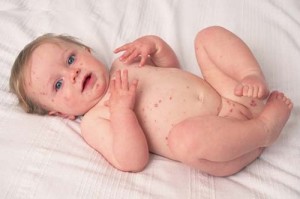 У ребенка аллергия по всему телу