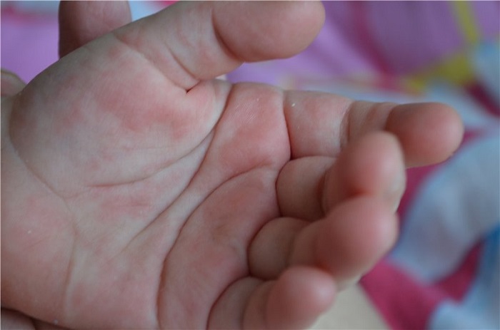 Рука ребенка с инфекцией