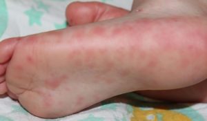 Нога ребенка с вирусом Коксаки