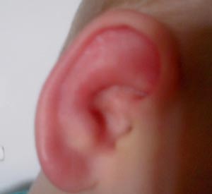 фото покрасневшего уха