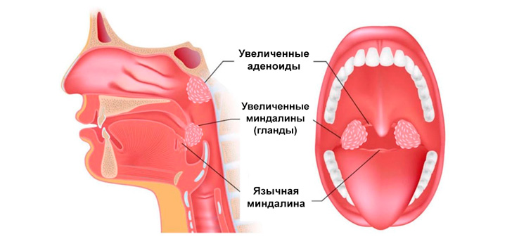 Расположение аденоидов в ротовой полости человека