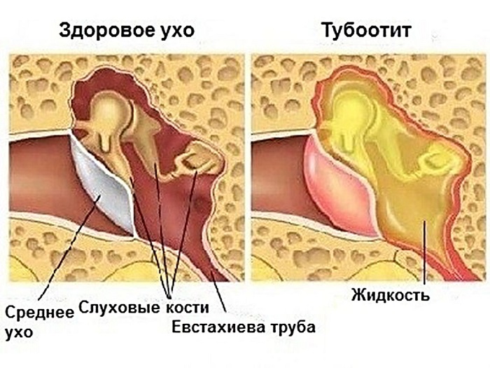 Схема строения здорового уха и с отитом у ребенка