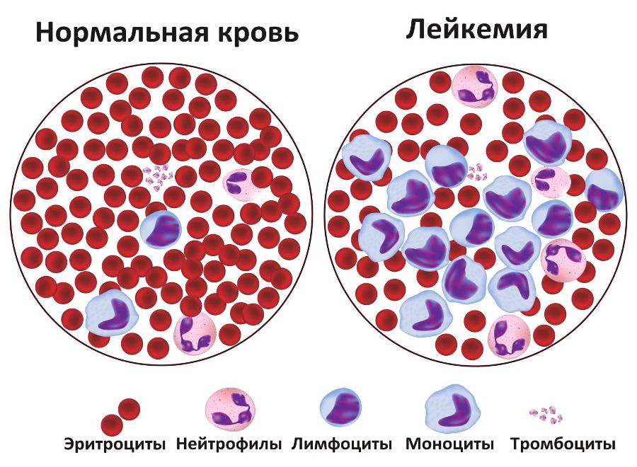 Нормальная кровь ребенка и больного лейкемией