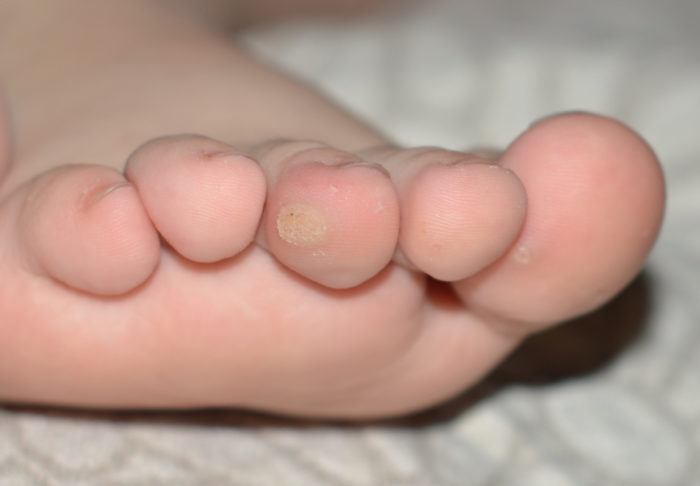Проблемная кожа у ребенка на пальцах ног