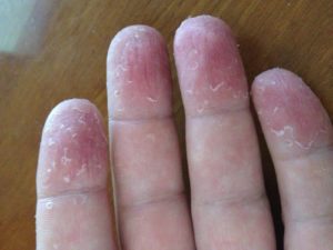 Шелушение кожи на пальцах рук у ребенка