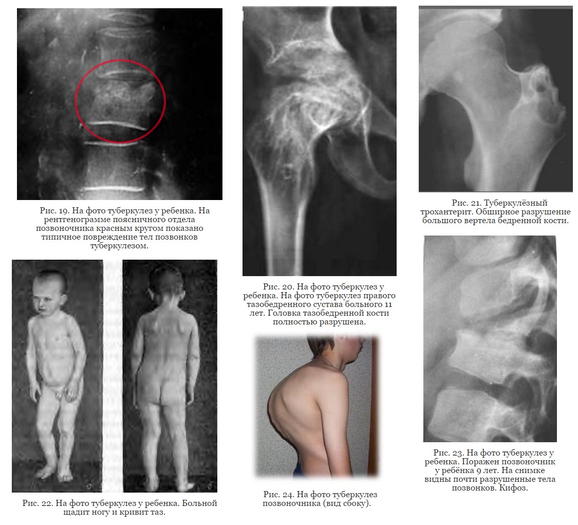 Фото и рентген-снимки внелегочного туберкулеза у детей